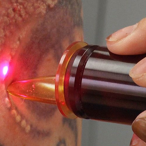 Laser_Tattoo_Removal_Alice_Pien_MD_AMAskincare Laser_Tattoo_Removal_Alice_Pien_MD_AMAskincare