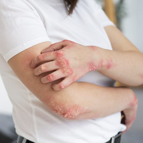 hands-patient-suffering-from-psoriasis Auto Immune Skin Disorders