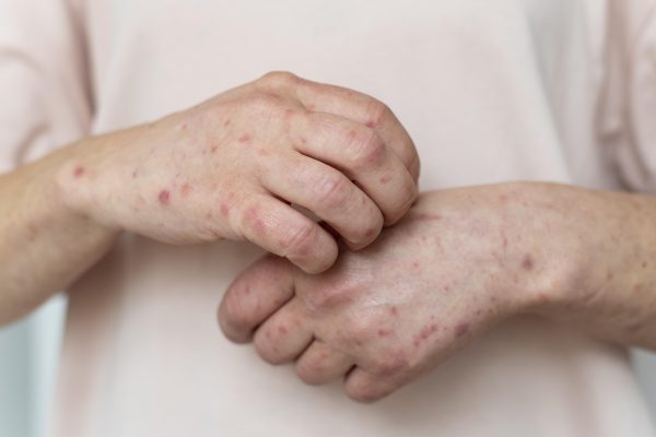 Skin Fungal Infections